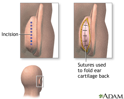 Procedure Procedure