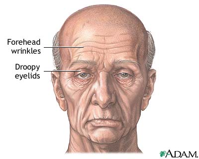 Forehead lift - series Forehead lift - series