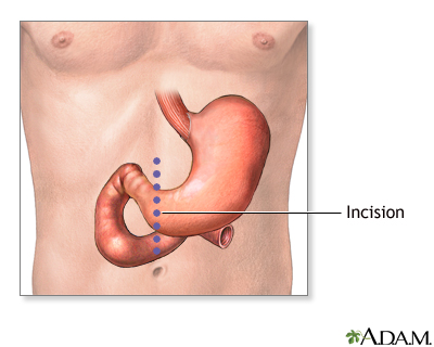 Gastrectomy incision Gastrectomy incision