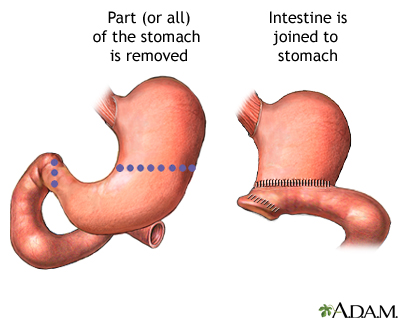 Gastrectomy Gastrectomy