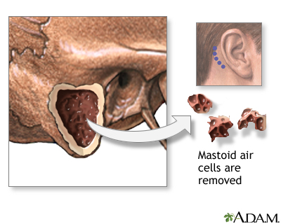 Mastoidectomy - Procedure Mastoidectomy - Procedure