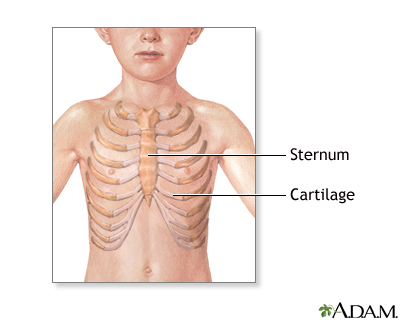 Pectus excavatum repair - series Pectus excavatum repair - series