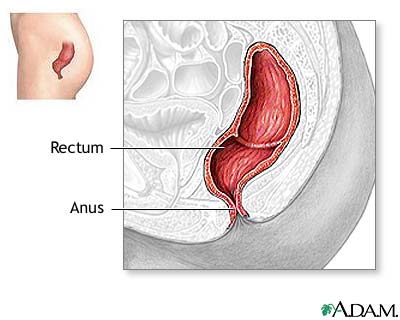 Rectal prolapse repair - series Rectal prolapse repair - series
