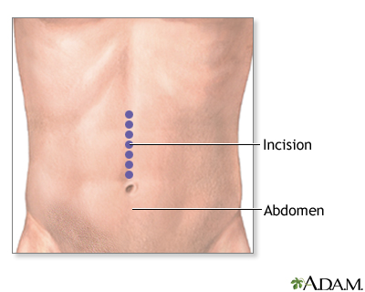 Incision Incision