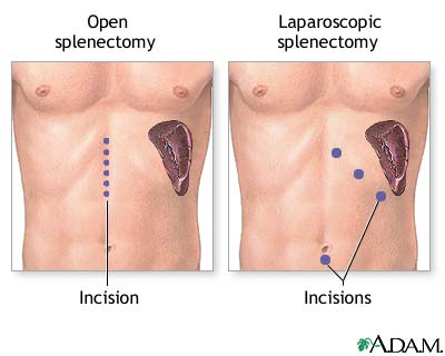Incision Incision