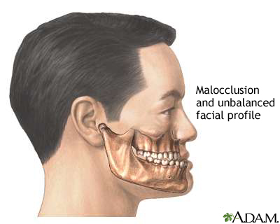 Malocclusion of teeth Malocclusion of teeth