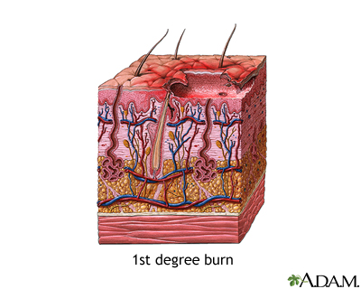 First degree burn First degree burn