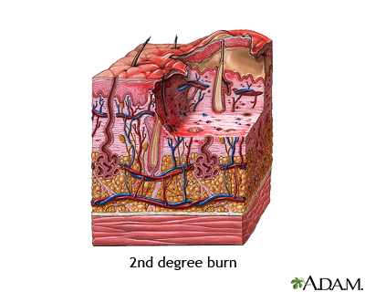 Second degree burn Second degree burn