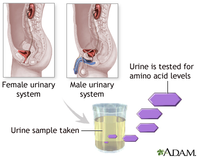 Aminoaciduria urine test Aminoaciduria urine test