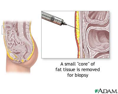 Fat tissue biopsy Fat tissue biopsy