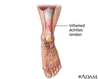 Inflamed Achilles tendon Inflamed Achilles tendon