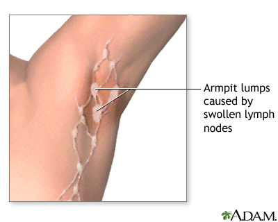 Swollen lymph nodes under arm Swollen lymph nodes under arm