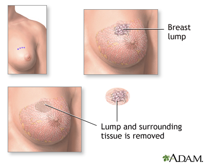 Excision of breast lump Excision of breast lump