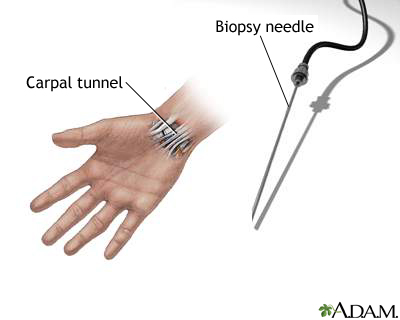 Carpal biopsy Carpal biopsy