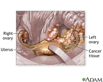Ovarian cancer Ovarian cancer