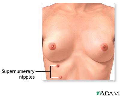 Supernumerary nipples Supernumerary nipples