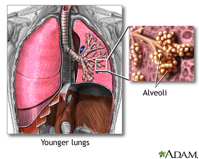 Normal lungs and alveoli Normal lungs and alveoli