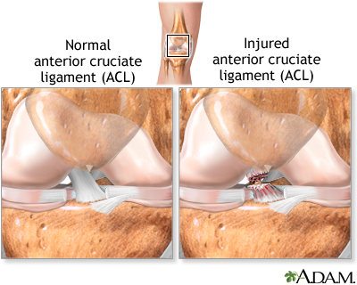 Anterior cruciate ligament (ACL) injury Anterior cruciate ligament (ACL) injury