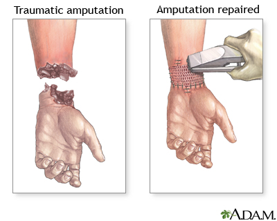 Amputation repair Amputation repair