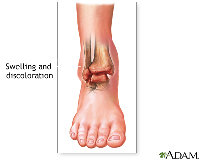 Sprained ankle Sprained ankle