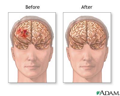 Before and after hematoma repair Before and after hematoma repair
