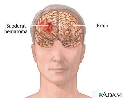 Subdural hematoma Subdural hematoma