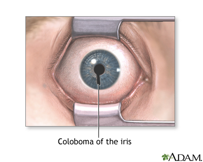 Coloboma of the iris Coloboma of the iris