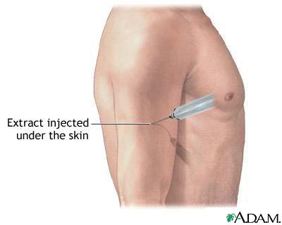Antigen injection Antigen injection