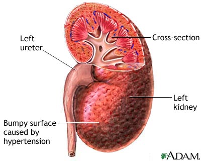 Hypertensive kidney Hypertensive kidney