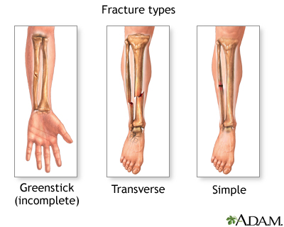 Fracture types (2) Fracture types (2)