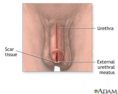 Meatal stenosis Meatal stenosis