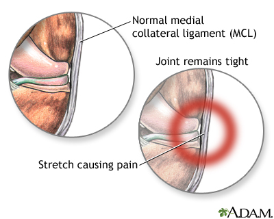 Medial collateral ligament pain Medial collateral ligament pain