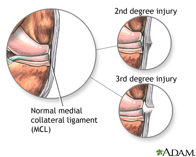 Medial collateral ligament injury Medial collateral ligament injury