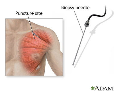 Muscle biopsy Muscle biopsy