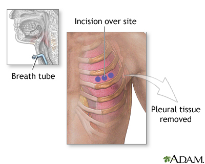 Incision for pleural tissue biopsy Incision for pleural tissue biopsy