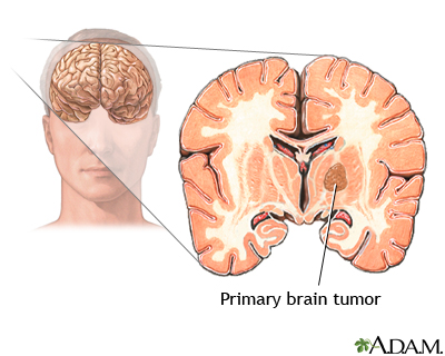 Primary brain tumor Primary brain tumor