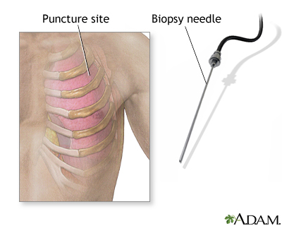 Pleural biopsy Pleural biopsy