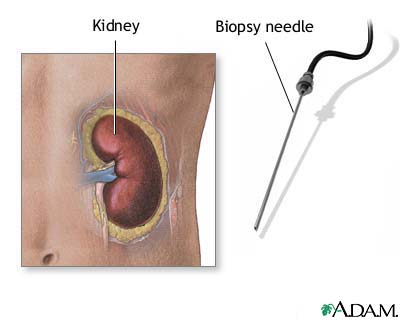 Renal biopsy Renal biopsy