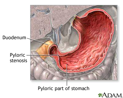 Pyloric stenosis Pyloric stenosis