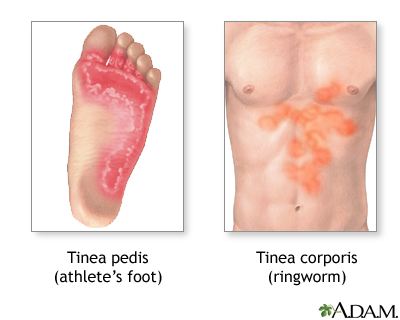 Tinea (ringworm) Tinea (ringworm)