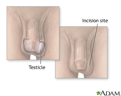 Testicular biopsy Testicular biopsy