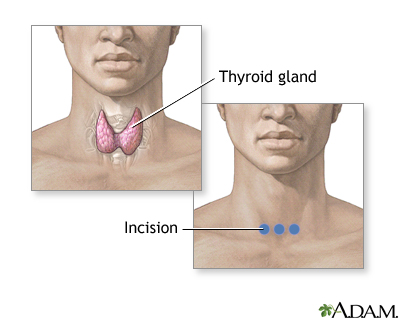 Incision for thyroid gland surgery Incision for thyroid gland surgery