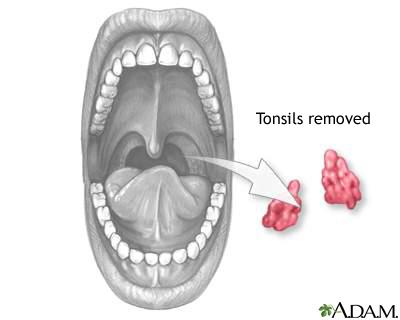 Tonsillectomy Tonsillectomy