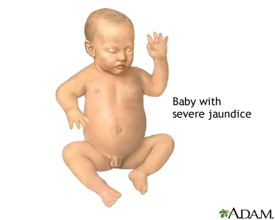 Infant jaundice Infant jaundice