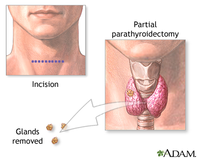 Parathyroidectomy Parathyroidectomy