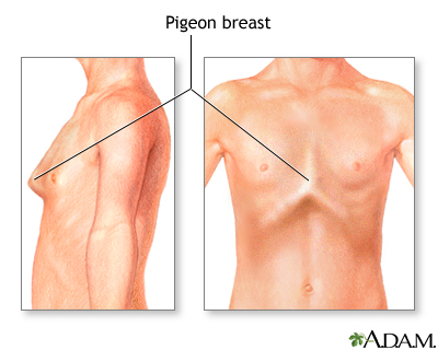 Bowed chest (pigeon breast) Bowed chest (pigeon breast)