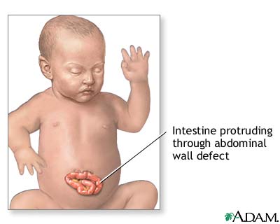 Infant abdominal hernia (gastroschisis) Infant abdominal hernia (gastroschisis)