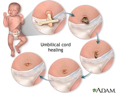 Umbilical cord healing Umbilical cord healing