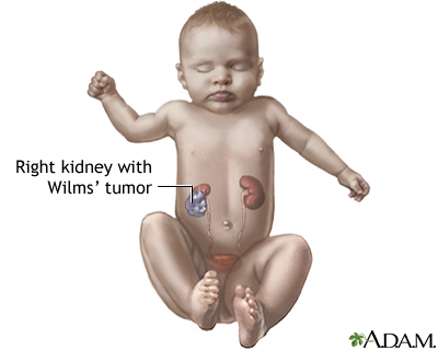 Wilms tumor Wilms tumor