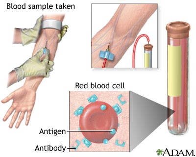 Antibody titer Antibody titer